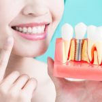 O que são Implantes Dentários