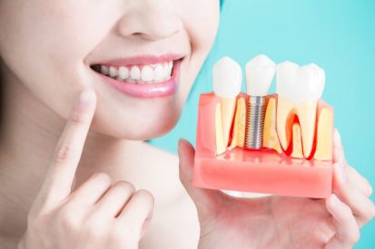 O que são Implantes Dentários