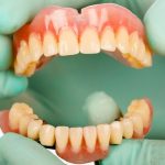 Guia das próteses dentárias: você sabe qual é a melhor para você?